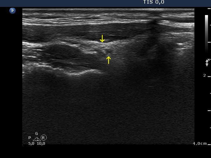 Right lobe, longitudinal scan