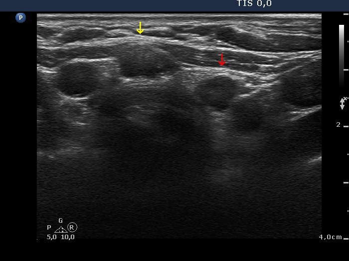 Right lobe, longitudinal scan
