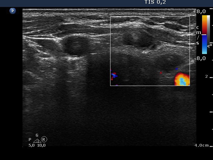 Right lobe, longitudinal scan