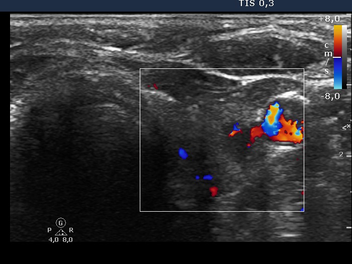Right lobe, longitudinal scan