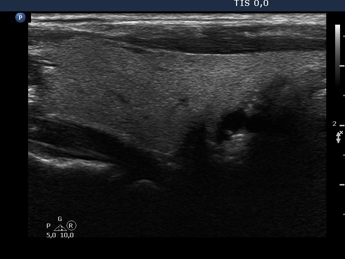 Right lobe, longitudinal scan
