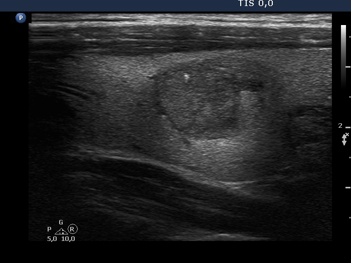 Right lobe, longitudinal scan
