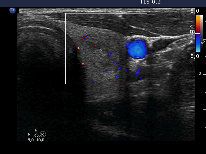 Right lobe, longitudinal scan
