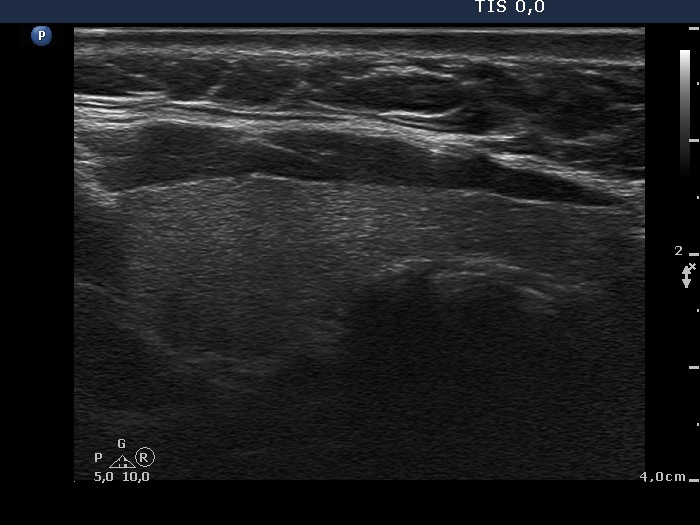 Right lobe, longitudinal scan