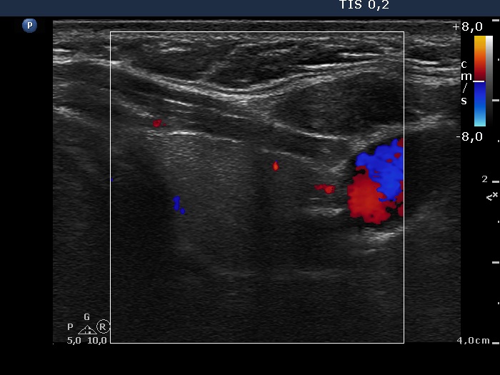 Right lobe, longitudinal scan