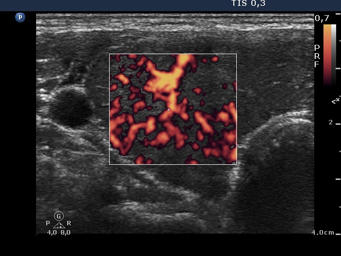 Right lobe, longitudinal scan