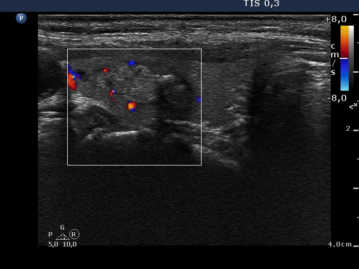 Right lobe, longitudinal scan