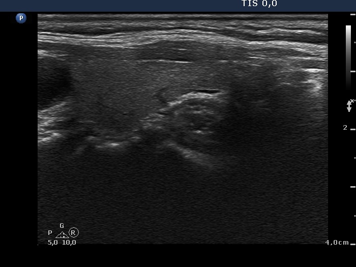 Right lobe, longitudinal scan