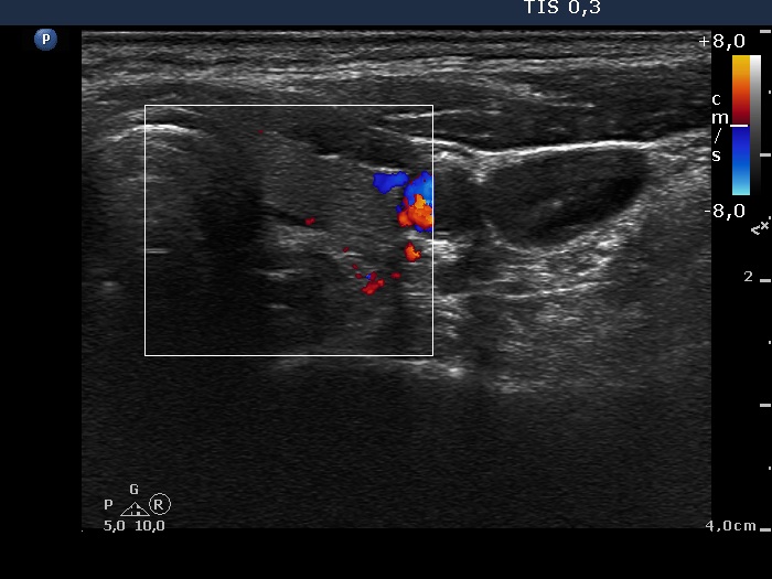 Right lobe, longitudinal scan