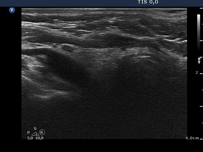 Right lobe, horizontal view
