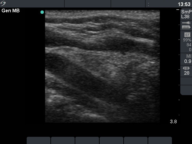 Right lobe, longitudinal scan