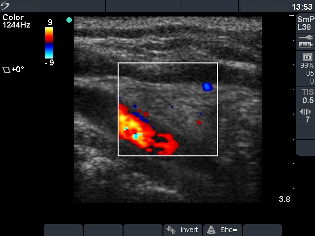 Right lobe, longitudinal scan