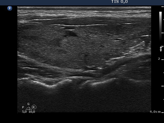 Right lobe, longitudinal scan