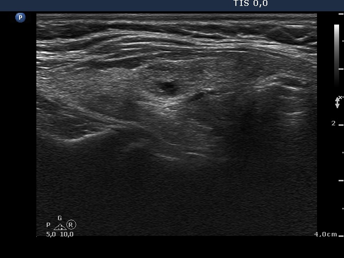 Right lobe, horizontal view