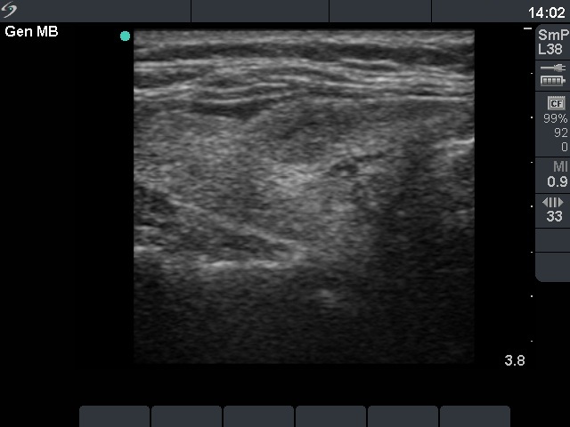 Right lobe, longitudinal scan