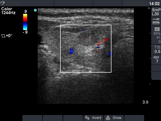 Right lobe, longitudinal scan