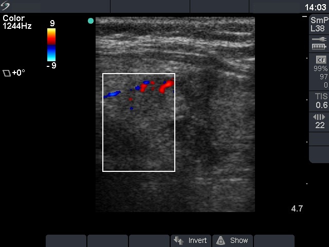 Right lobe, longitudinal scan