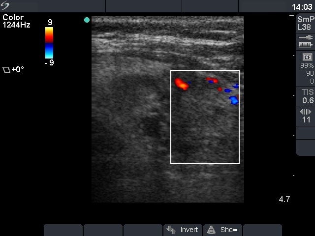 Right lobe, longitudinal scan
