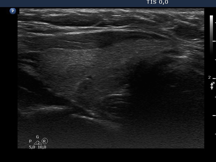 Right lobe, longitudinal scan