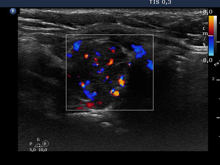 Right lobe, longitudinal scan