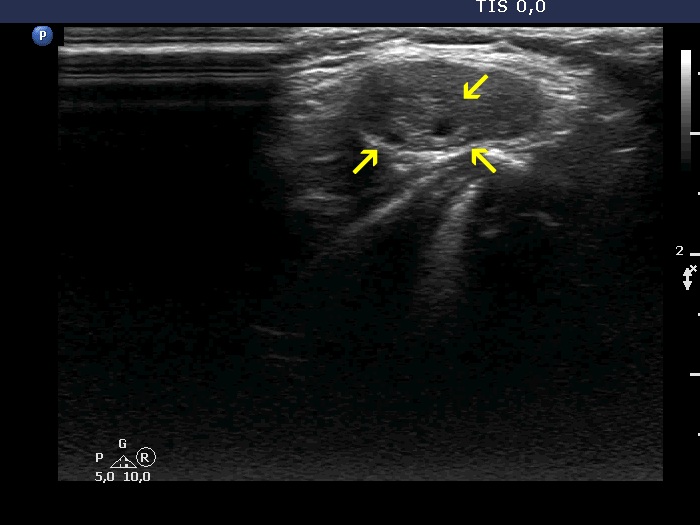 Right lobe, longitudinal scan