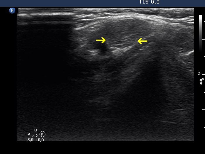 Right lobe, longitudinal scan