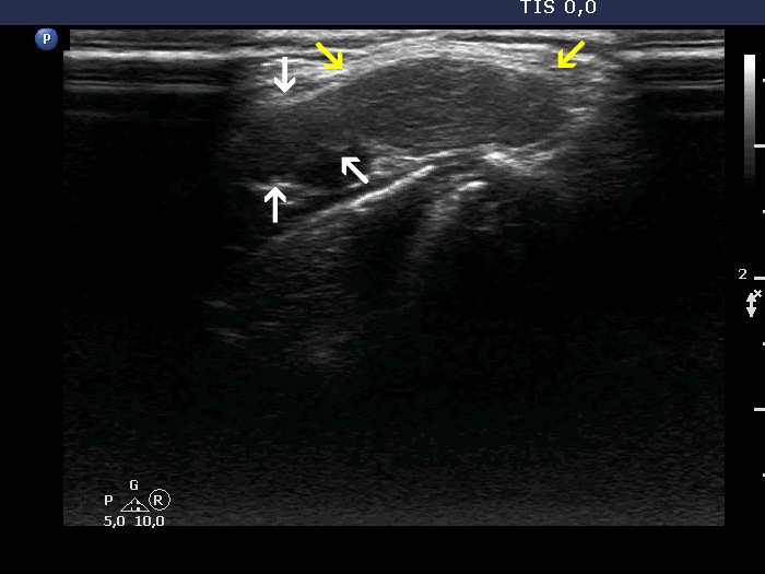 Right lobe, longitudinal scan