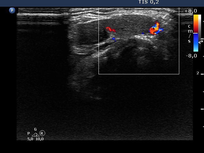 Right lobe, longitudinal scan