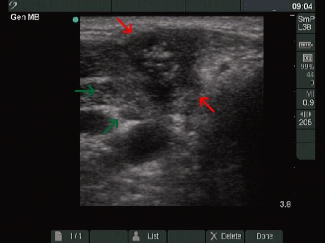 Right lobe, longitudinal scan