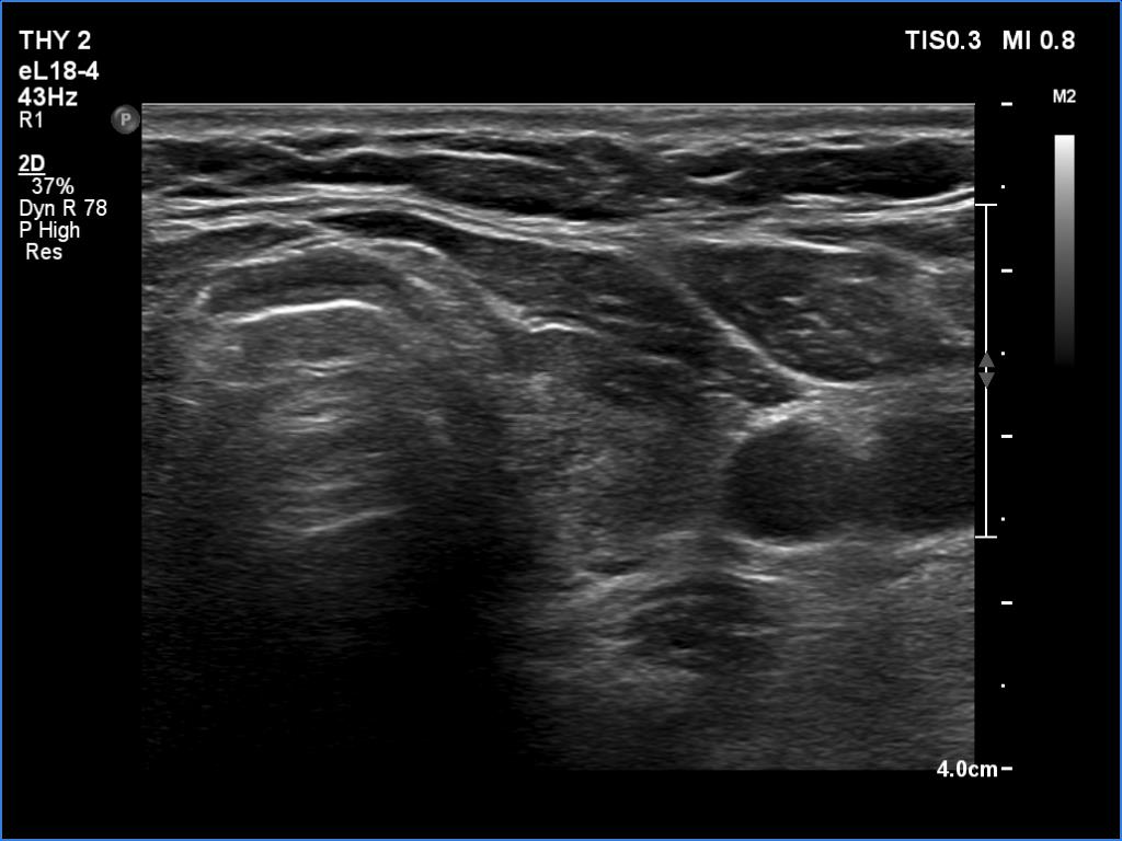 Right lobe, longitudinal scan