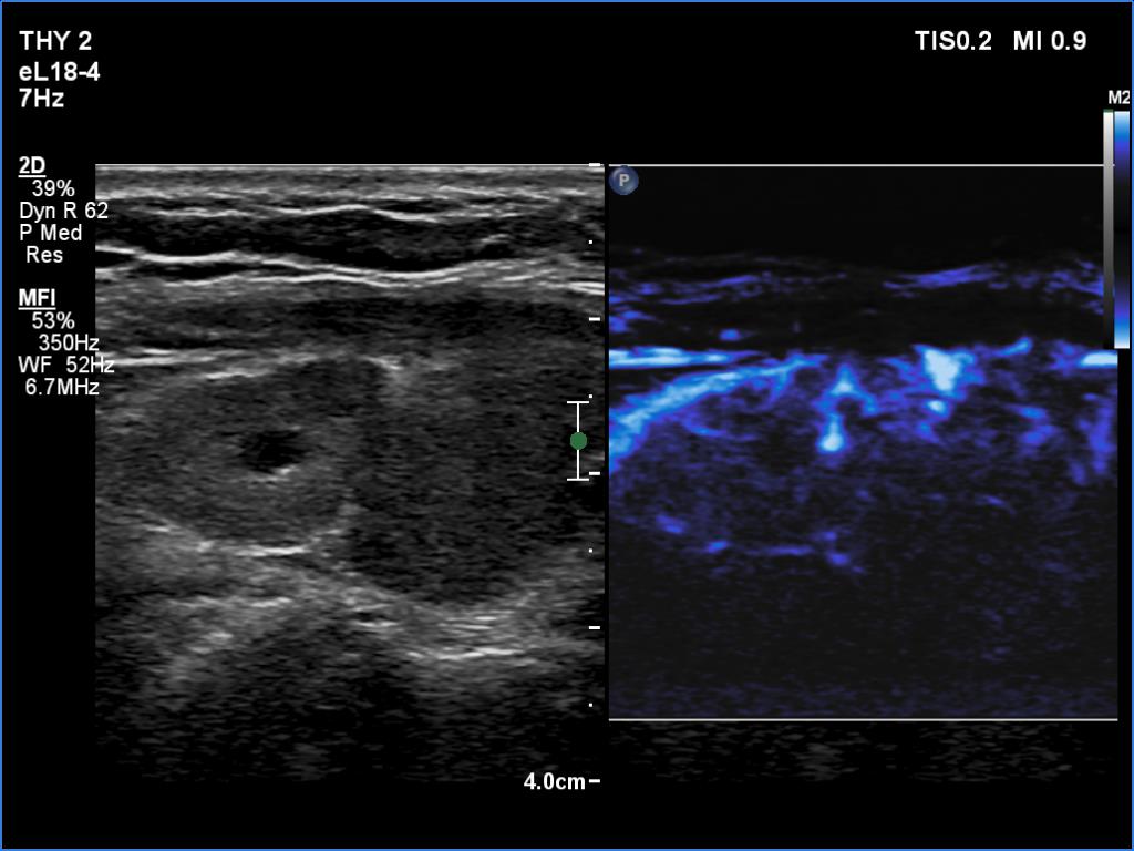 Right lobe, longitudinal scan