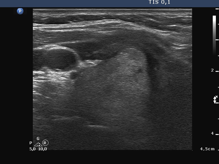 Right lobe, longitudinal scan