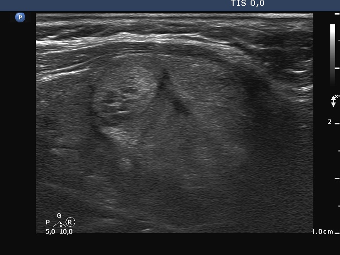 Right lobe, longitudinal scan