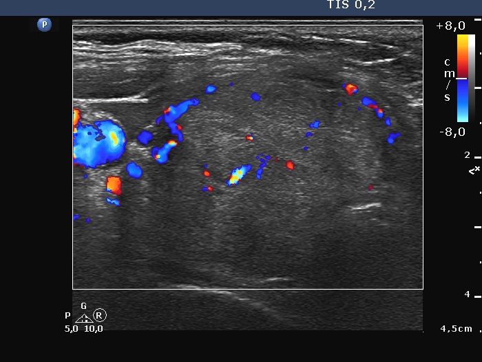 Right lobe, longitudinal scan