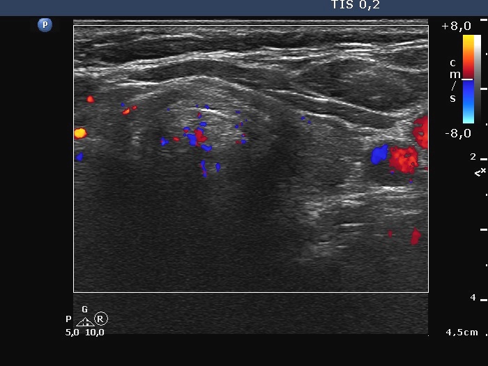 Right lobe, longitudinal scan