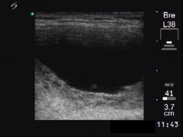 Right lobe, longitudinal scan