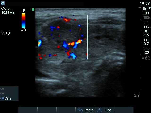 Right lobe, longitudinal scan