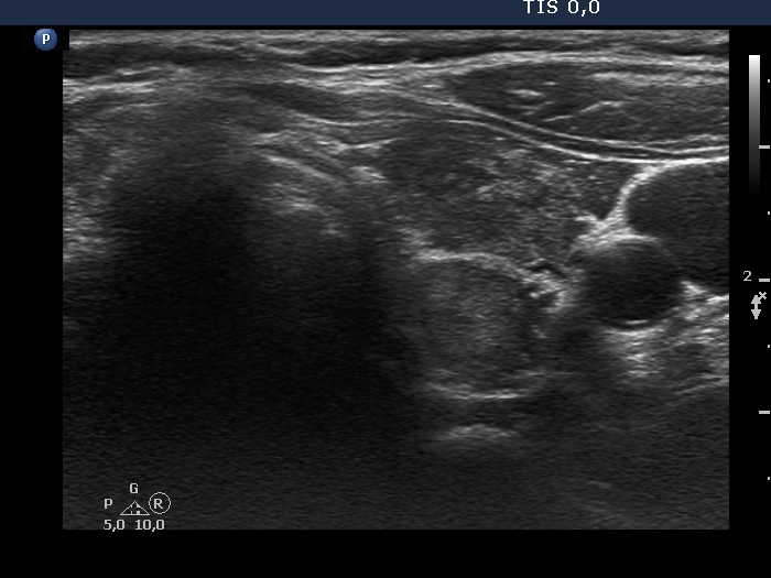 Right lobe, longitudinal scan
