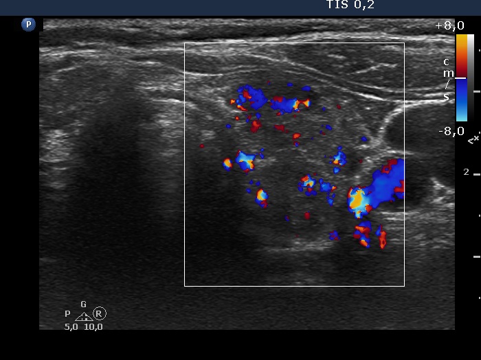 Right lobe, longitudinal scan