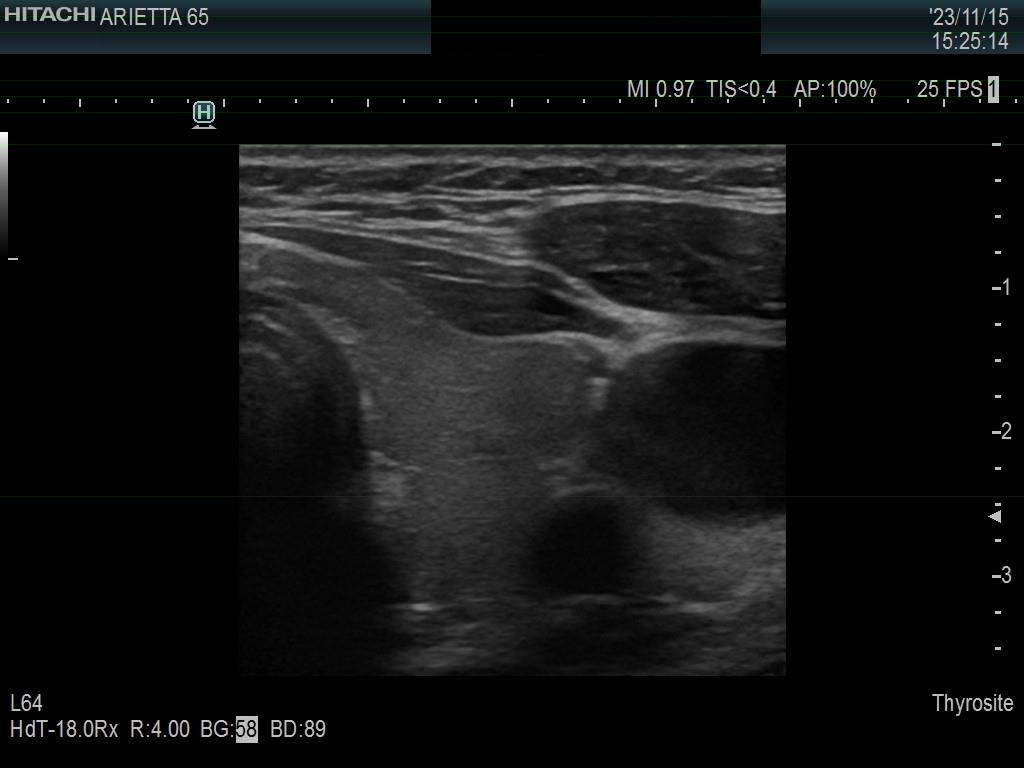 Right lobe, longitudinal scan