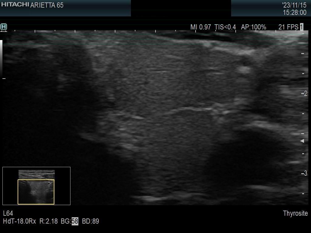 Right lobe, longitudinal scan