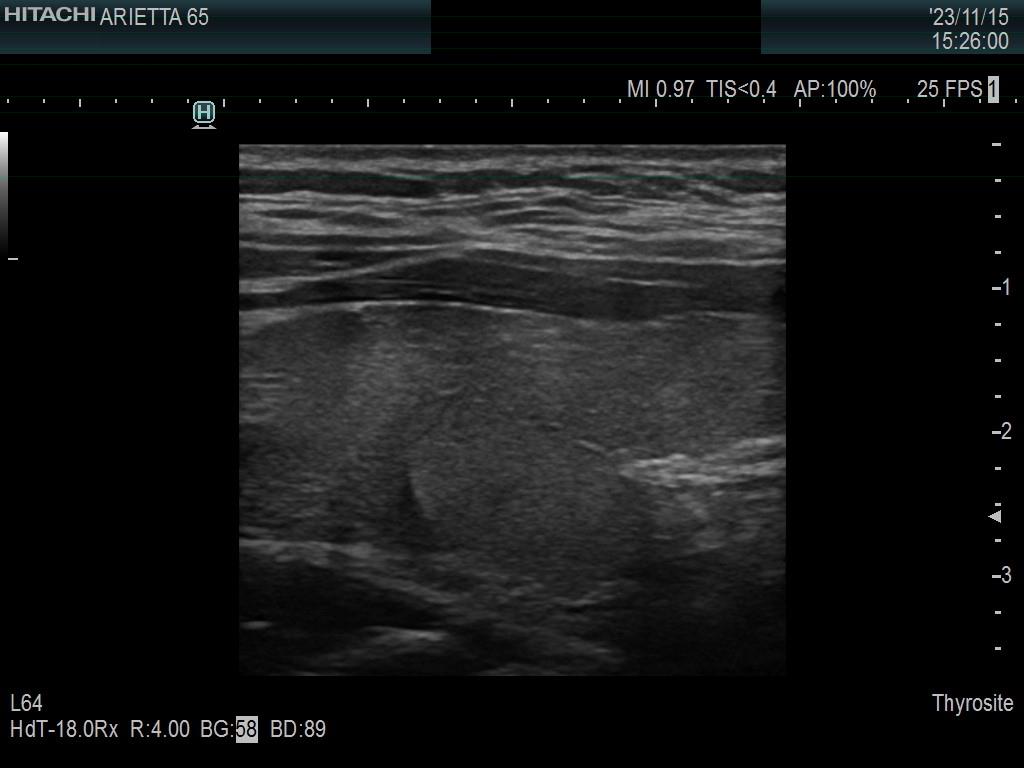 Right lobe, longitudinal scan
