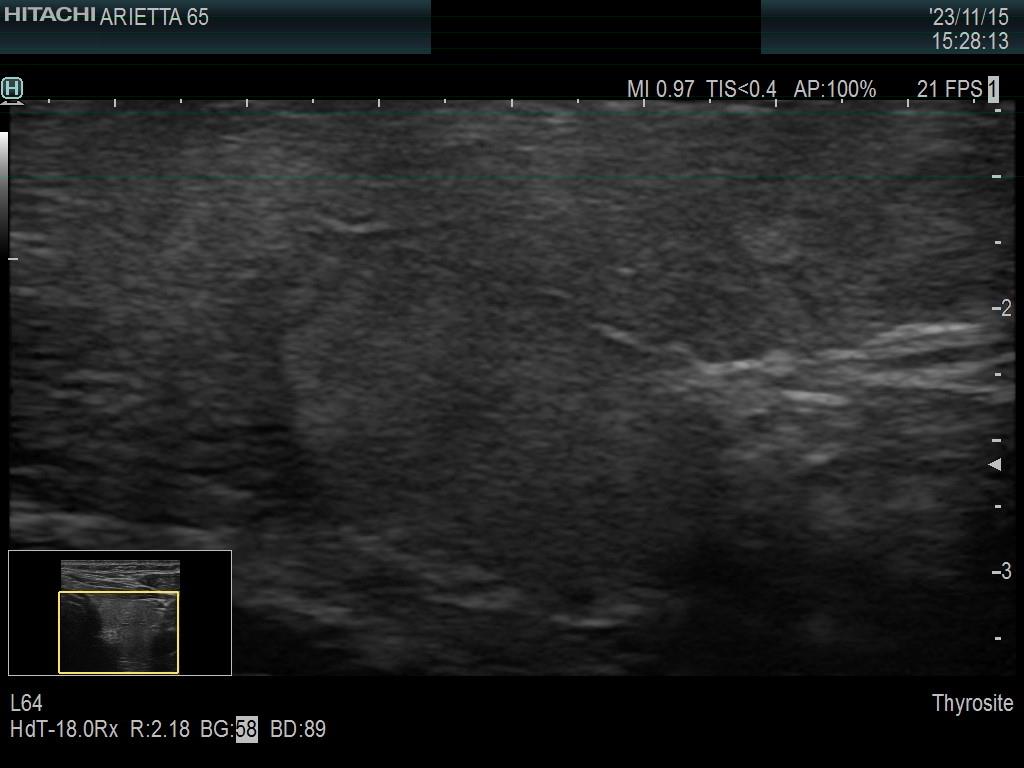 Right lobe, longitudinal scan