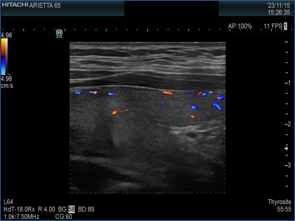 Right lobe, longitudinal scan