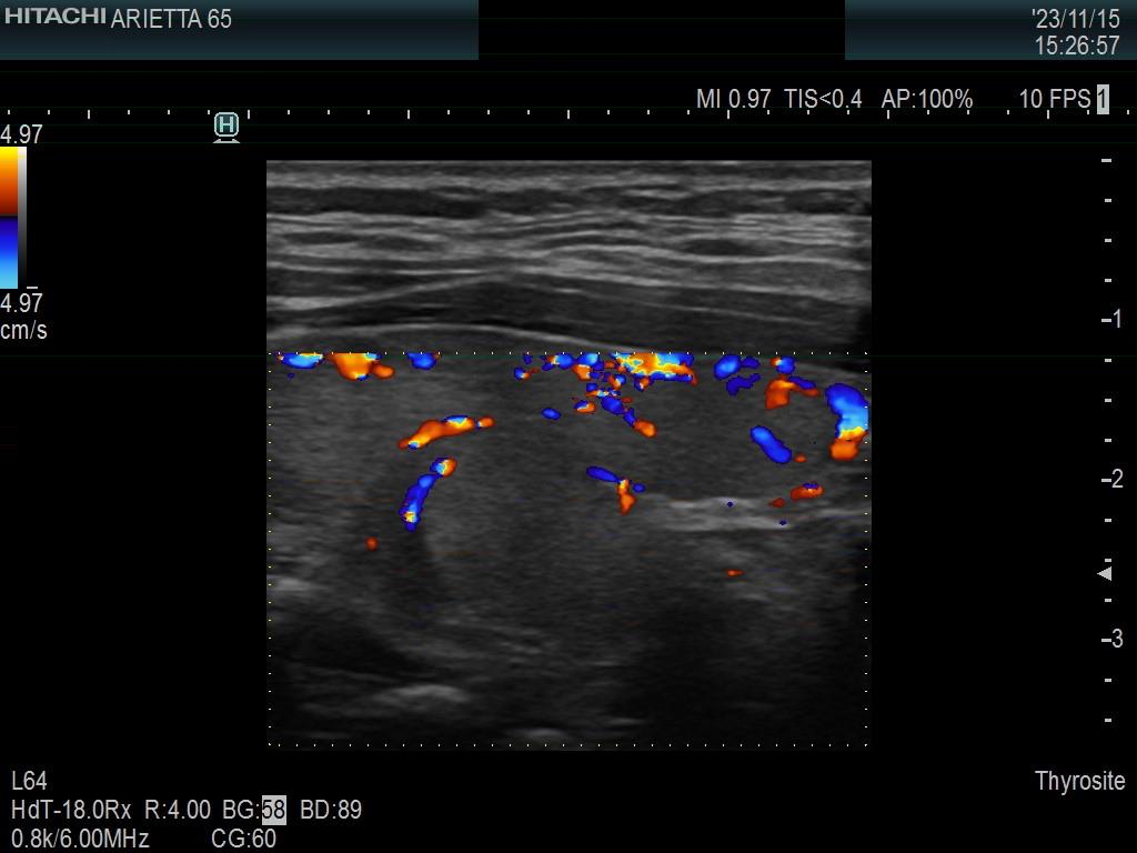 Right lobe, longitudinal scan