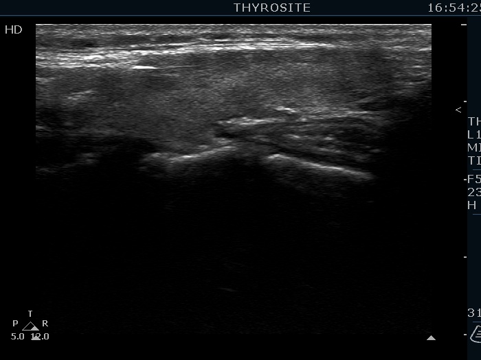Right lobe, longitudinal scan