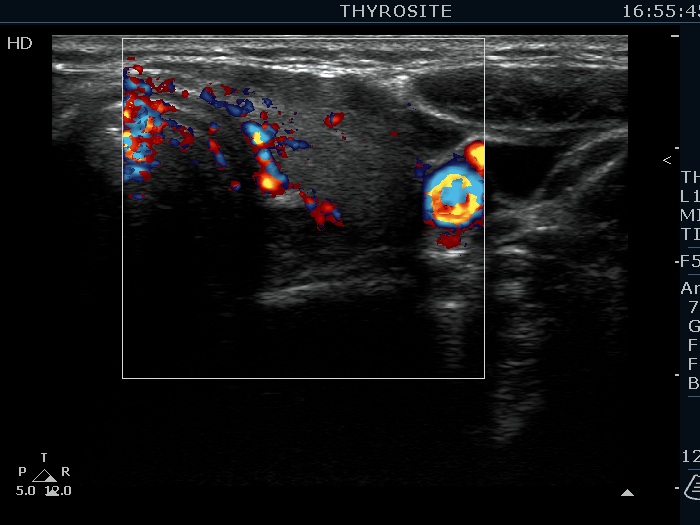 Right lobe, longitudinal scan