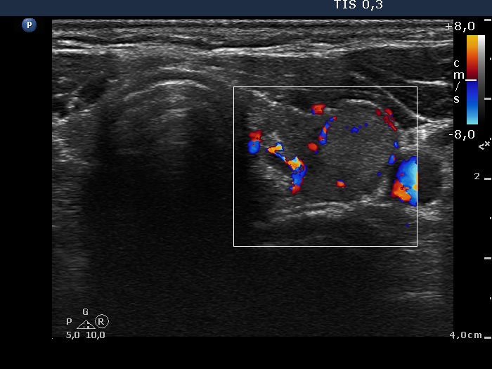 Right lobe, longitudinal scan