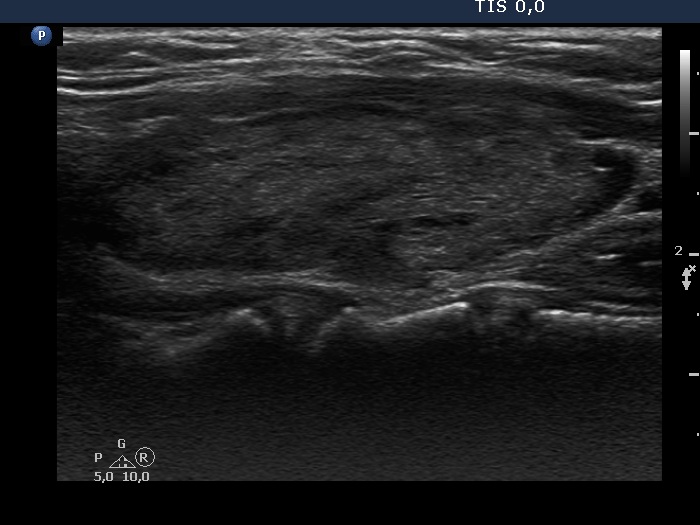 Right lobe, longitudinal scan