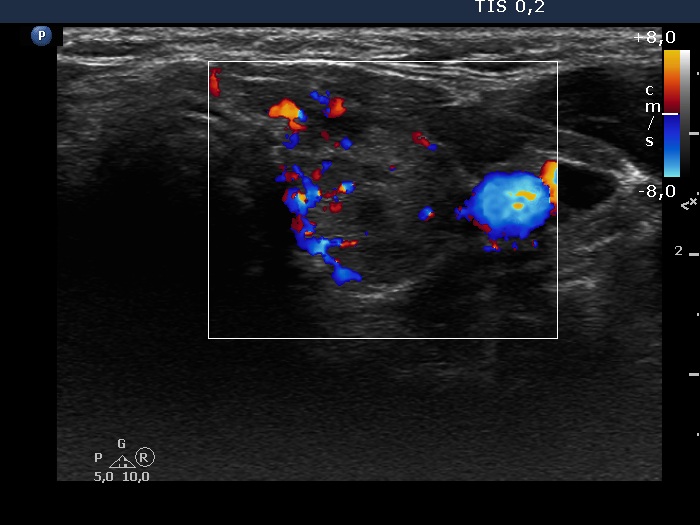 Right lobe, longitudinal scan